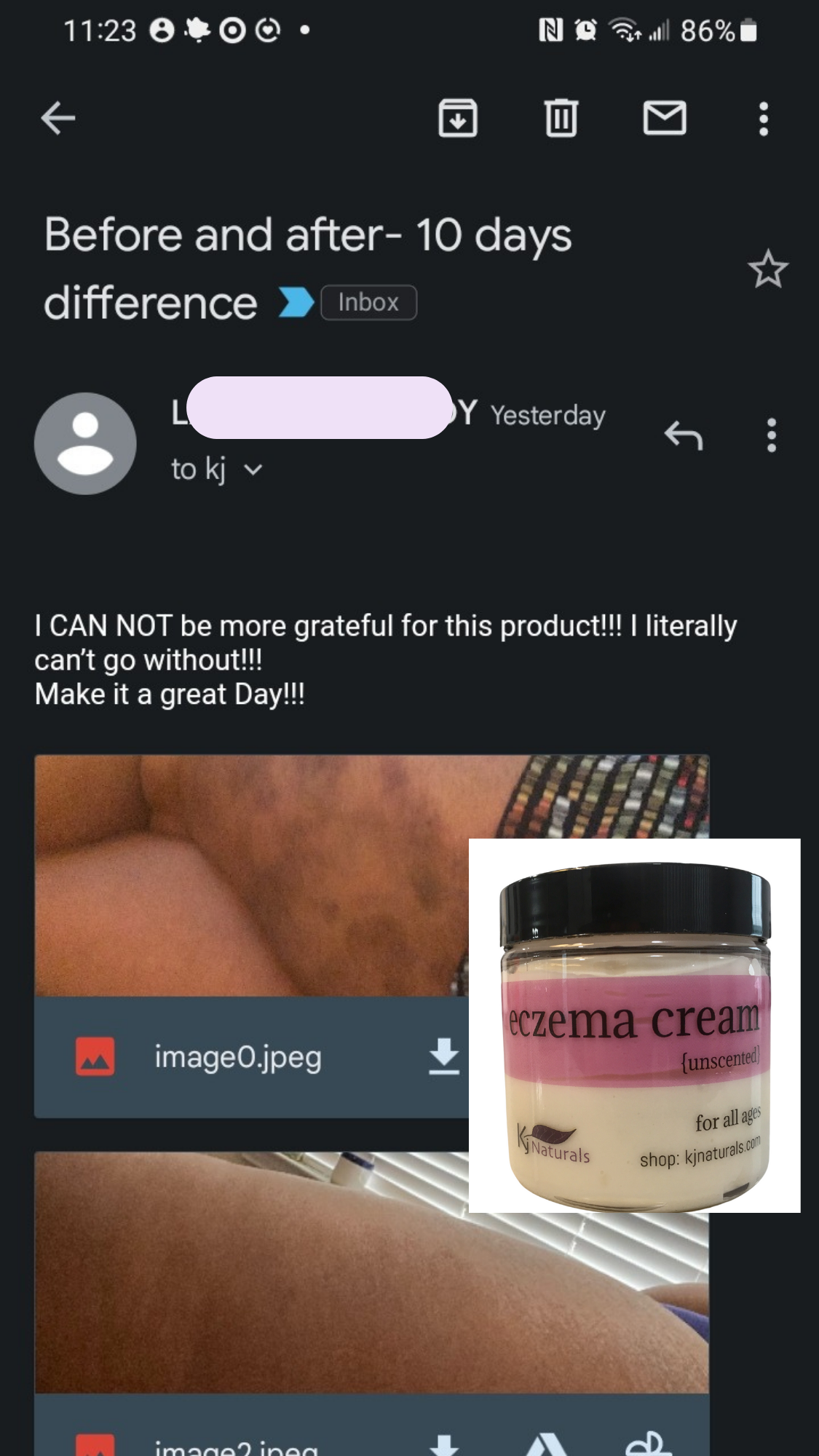 Natural Eczema Cream- NO steroids! For daily all-over use or problem areas.