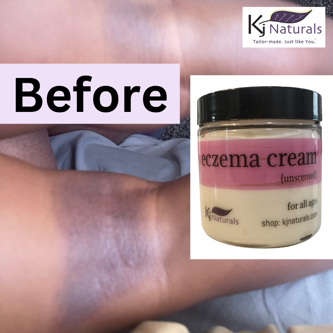 Natural Eczema Cream- NO steroids! For daily all-over use or problem areas.