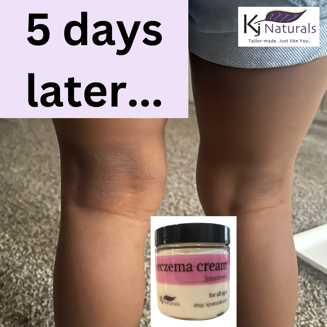 Natural Eczema Cream- NO steroids! For daily all-over use or problem areas.